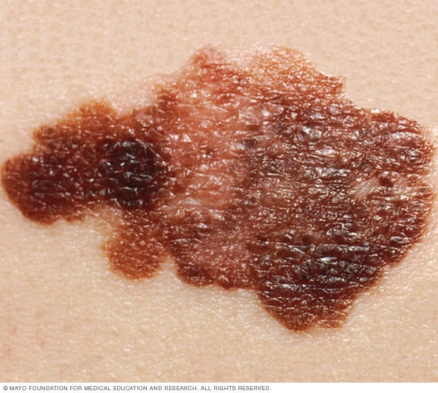 cancer that starts as a growth of cells on the skin