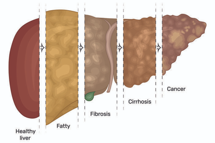 Stages of Liver Damage